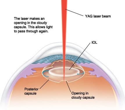 YAG Laser Types, Treatment Benefits, Risks & Cost.